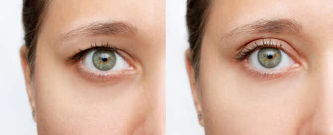 Die Oberlidkorrektur, auch Blepharoplastik genannt, ist ein schonender chirurgischer Eingriff, der überschüssige Haut oder Fettgewebe im Bereich der oberen Augenlider entfernt. Ziel ist es, das Gesichtsfeld wieder zu erweitern und einen wachen, verjüngten Gesichtsausdruck zu erzielen: Vorteile, Risiken und FAQs im Überblick.